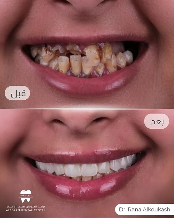 حالة قبل وبعد من علاج دكتورة رنا الكوكاش