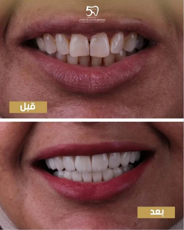 حالة قبل وبعد من علاج دكتورة رنا الكوكاش