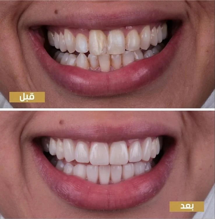 حالة قبل وبعد من علاج دكتورة رنا الكوكاش