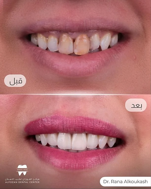 حالة قبل وبعد من علاج دكتورة رنا الكوكاش