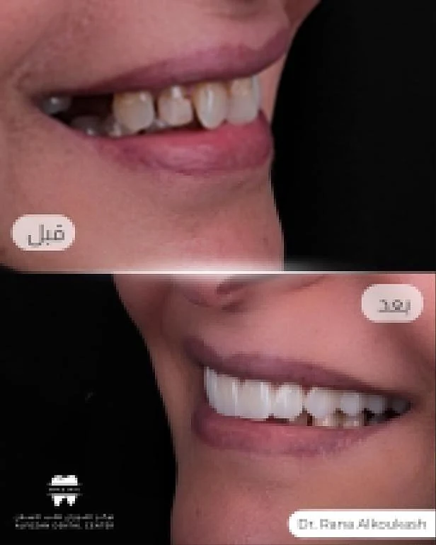 حالة قبل وبعد من علاج دكتورة رنا الكوكاش